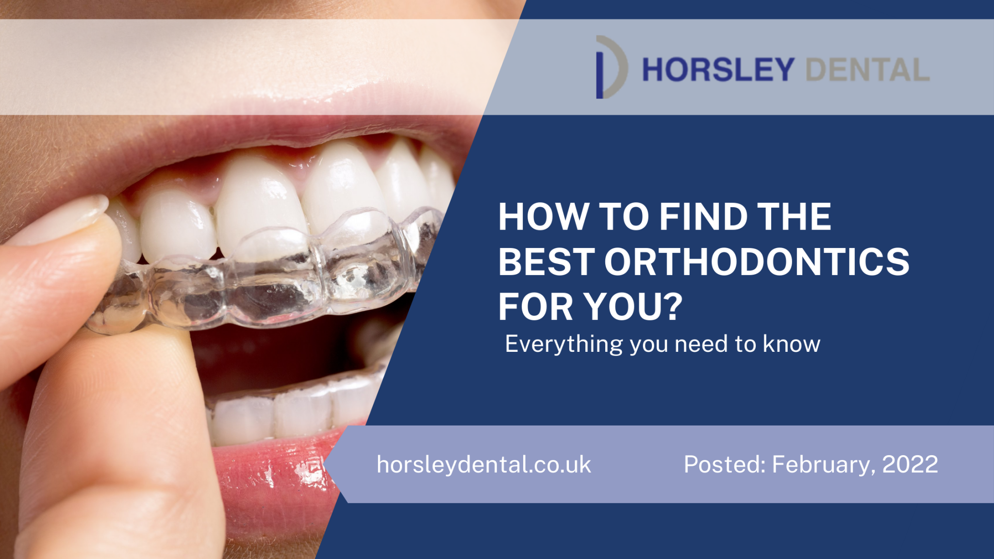 How To Find The Best Orthodontics For You? Horsley dental blog